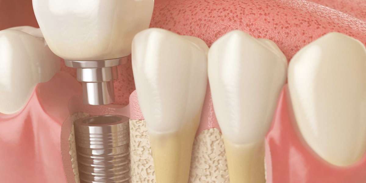 Dental Implants Market New Business Opportunities and Investment Research Study During 2022-2030