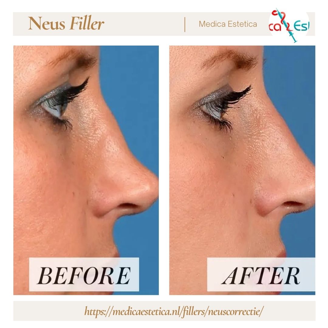 What I Should Know Before Getting neus filler (nose filler)? | TechPlanet