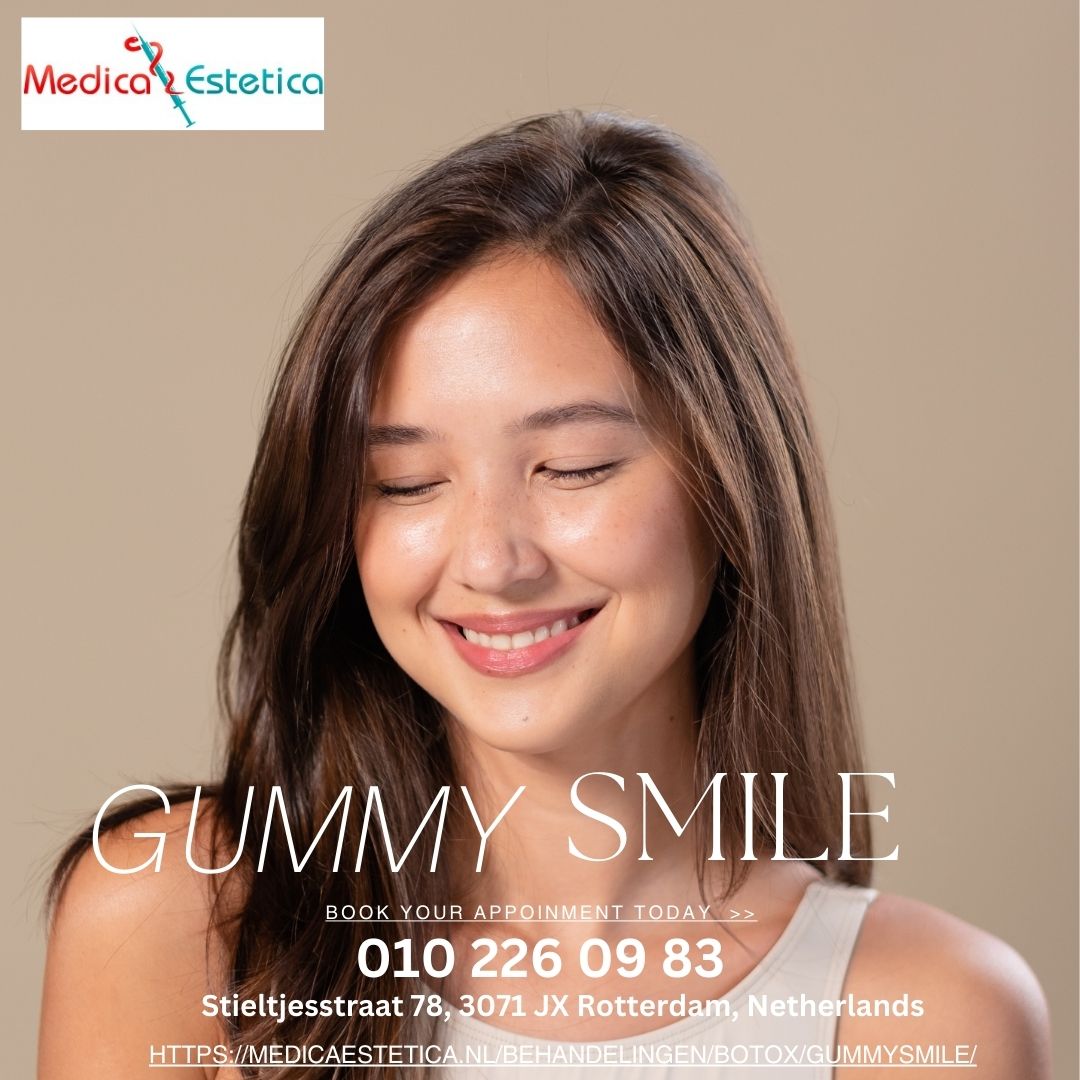 Botox for Gummy Smile? Can It Be an Ultimate Treatment? – Just another WordPress site